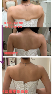 最短1ヶ月ブライダルエステでドレスをキレイに着こなせちゃいました!Salon de M jolieのブライダルエステ