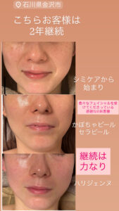 サロンドエムジョリーでフェイシャルを継続されているお客様の画像